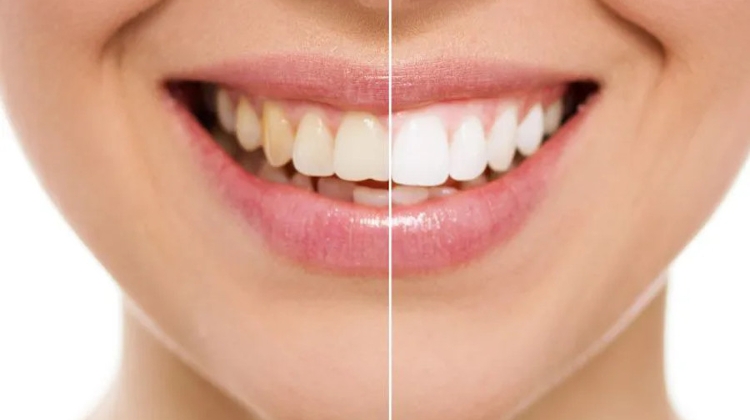Professional Teeth Whitening vs. At-Home Whitening, by Evergreen Dental Budapest