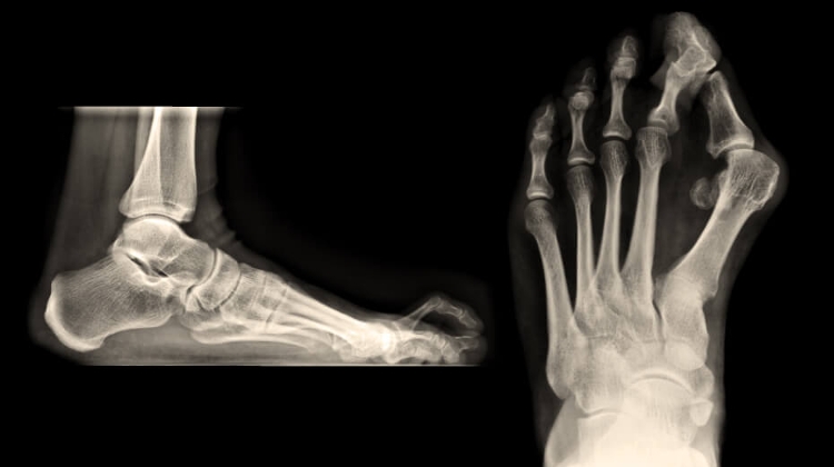 Dr. Rose Private Hospital Budapest Insight: Bunions & Hammertoes - Prevention &Treatment Dr. Rose Private Hospital Budapest Insight: Bunions & Hammertoes - Prevention &Treatment