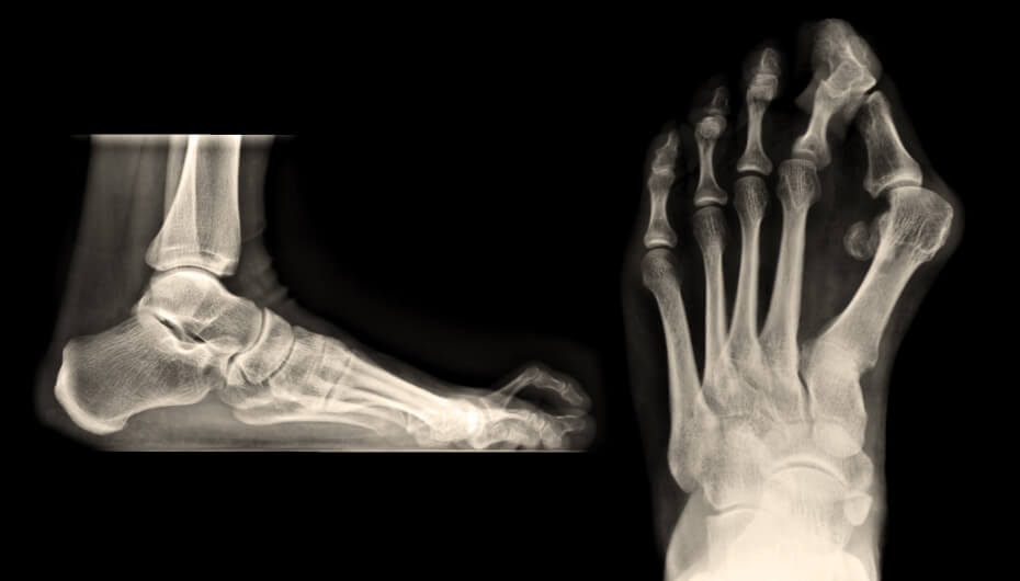Dr. Rose Private Hospital Budapest Insight: Bunions & Hammertoes - Prevention &Treatment