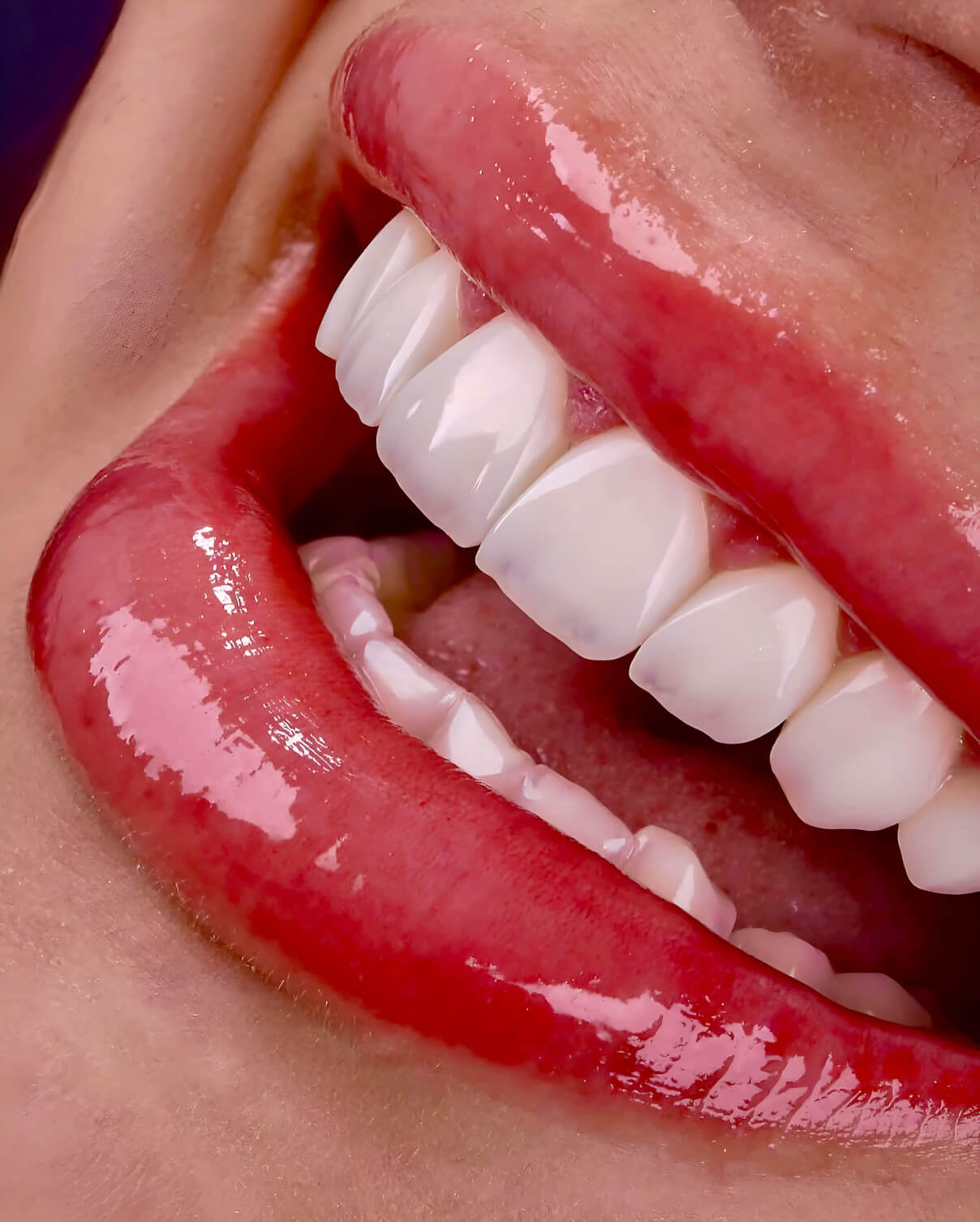 Aestella Dental Clinic Insight: All You Need to Know about Veneers