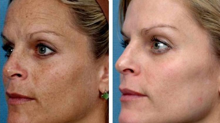 Special 3 Step Skin Rejuvenation At Wellmed Budapest