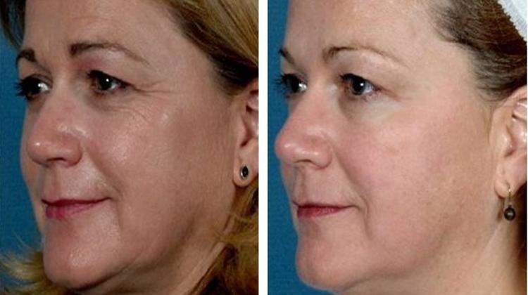 Refirm SkinTightening  @ Wellmed Beauty Budapest