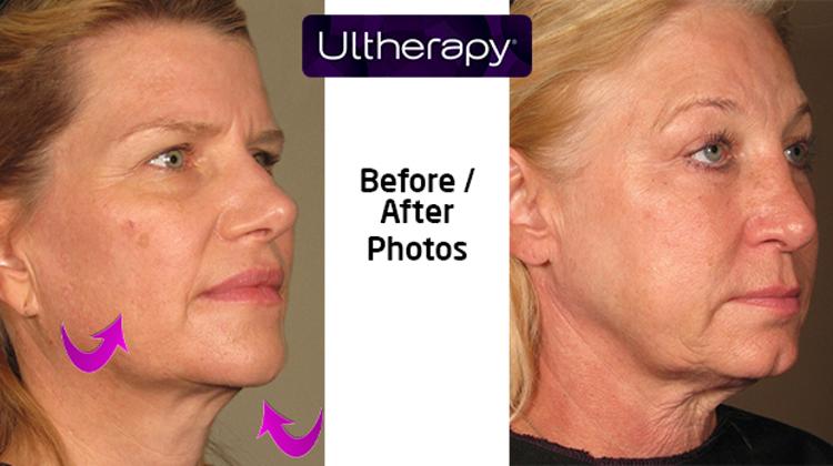 Ultherapy Treatment @ Oxygen Medical Budapest